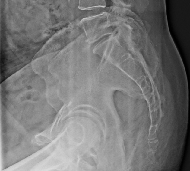 Coccyx fracture | Radiology Case | Radiopaedia.org